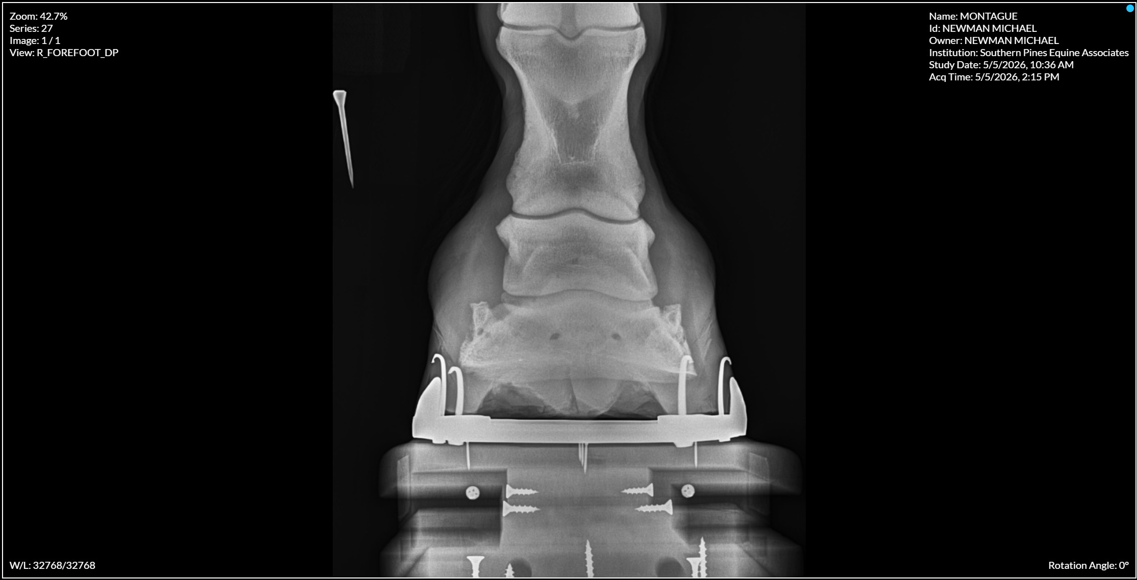 Right Forefoot DP